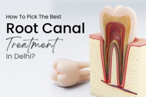 Affordable Root Canal Therapy