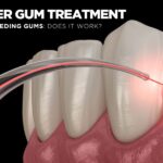 Laser Gum Treatment in Delhi