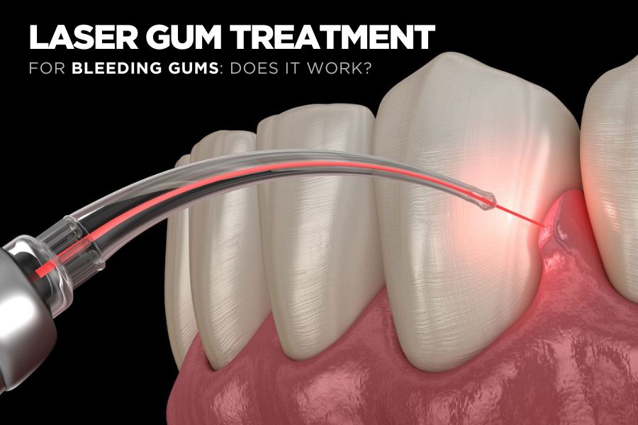 Laser Gum Treatment in Delhi