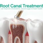root canal treatment
