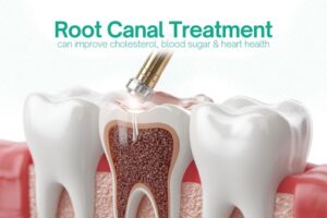 root canal treatment